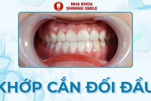 Cách Khắc Phục Niềng Răng Khớp Cắn Đối Đầu Hiệu Quả