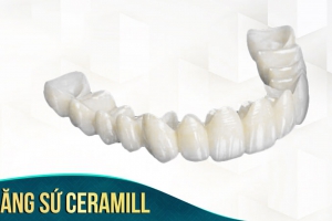Răng sứ Ceramill: Răng toàn sứ Đức cao cấp