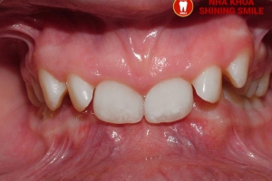 Quy Trình Niềng Răng Khớp Cắn Sâu: Giải Pháp Tại Nha Khoa Shining Smile