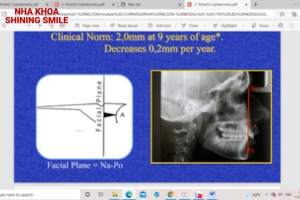 Thách Thức Trong Các Case Niềng Răng Khó: Giải Pháp Từ Nha Khoa Shining Smile