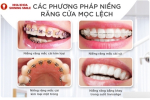 Biến Hóa Nụ Cười Với Niềng Răng Cửa Bị Lệch: Phương Pháp Chỉnh Nha Hiệu Quả