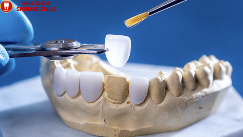 Răng Sứ Bị Vỡ Có Hàn Được Không? Hướng Dẫn Xử Lý