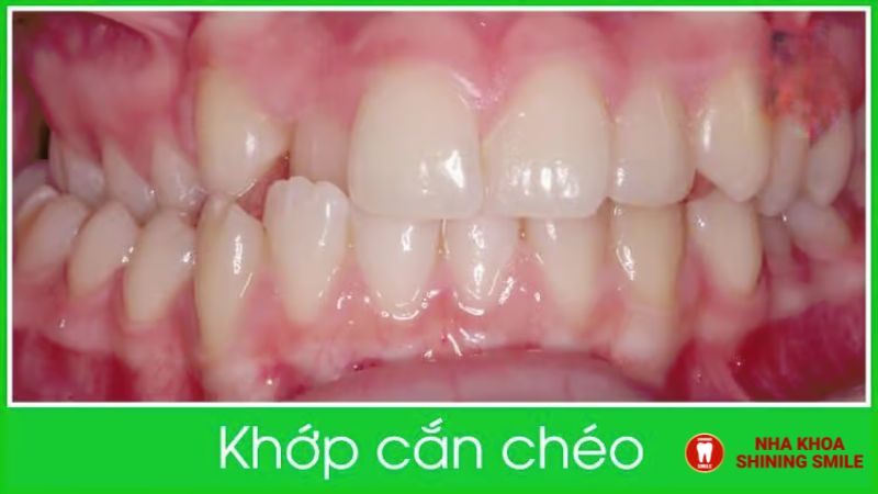 Răng Sứ Cao Cấp: Lựa Chọn Hoàn Hảo Cho Nụ Cười Đẹp