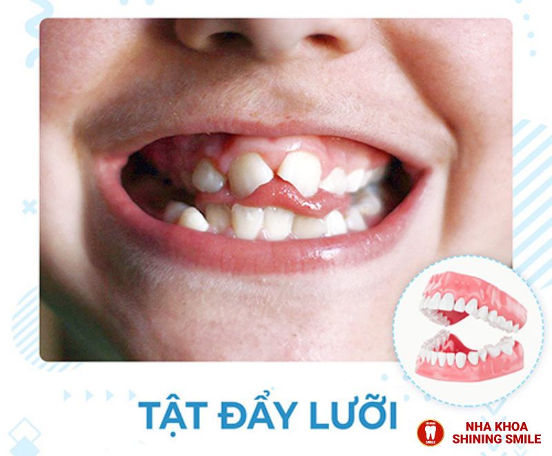 Niềng Răng và Nhổ Răng Số 8: Liệu Có Nguy Hiểm?