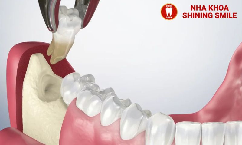 Khám Phá Những Tác Hại Tiềm Ẩn Của Niềng Răng