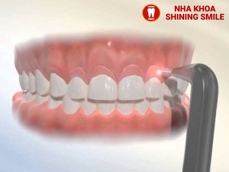 Niềng Răng Khi Chưa Mọc Răng Khôn: Có Khả Thi Không?