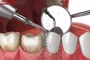 Bọc Răng Sứ Có Lấy Cao Răng Được Không? Hướng Dẫn Chi Tiết