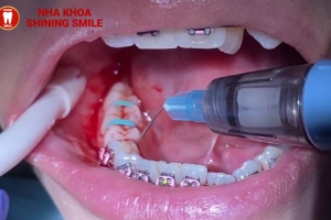 27 Tuổi Có Niềng Răng Được Không? Chuyên Gia Tư Vấn