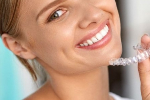 Răng Chạy Nhanh Khi Niềng: Hiệu Quả Và Tác Động