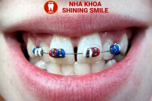 Niềng 4 Cái Răng: Giải Pháp Hiệu Quả Cho Vấn Đề Răng Miệng Cụ Thể