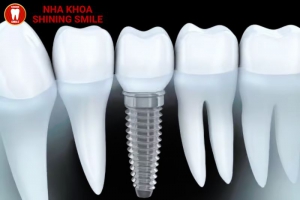 Hiểu Rõ Về Trồng Răng Sứ Cố Định: Lợi Ích và Tuổi Thọ