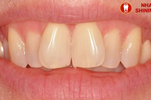 Bọc Răng Sứ Có Được Bảo Hiểm Không? Thông Tin Quan Trọng