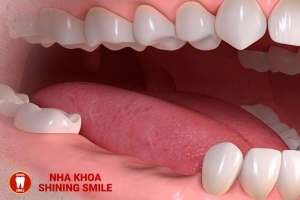 Khám Phá Trồng Răng Implant All On 4: Phương Pháp Hiệu Quả Cho Người Mất Nhiều Răng