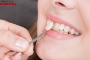 Kinh Nghiệm Dán Răng Sứ Veneer: Những Điều Cần Lưu Ý