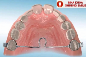 Hiểu Rõ Về Neo Chặn Trong Chỉnh Nha Tại Nha Khoa Shining Smile