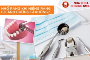 Phải Nhổ Răng Khi Niềng Răng Không? Hiểu Đúng Để Không Lo Lắng
