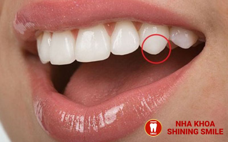 Nhược Điểm Của Trồng Răng Implant - Những Điều Cần Biết Trước Khi Quyết Định