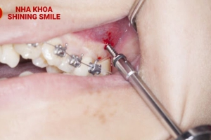 Nguyên Nhân và Cách Khắc Phục Khi Cắm Vít Niềng Răng Bị Sưng Viêm