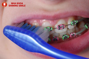 Giải Pháp Xử Lý Dây Thun Niềng Răng Bị Vàng: Hướng Dẫn Làm Sáng Lại Nụ Cười