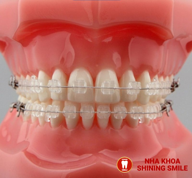 Tìm Hiểu Về Quá Trình Niềng Răng Lần 2: Những Điều Cần Lưu Ý