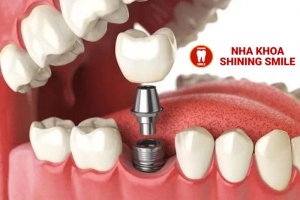 Giải Đáp Thắc Mắc: Trồng Răng Implant Có Đau Không?