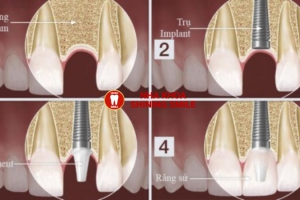 Trồng Răng Có Đau Không? Sự Thật Bạn Cần Biết!