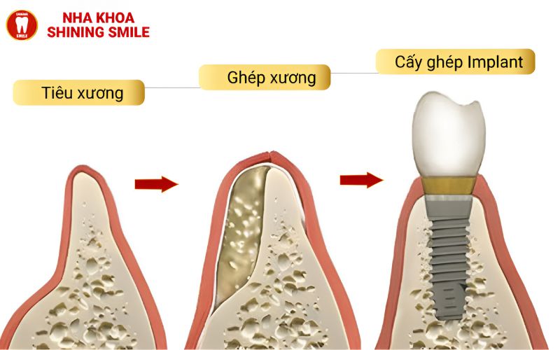 Làm Răng Giả Nguyên Hàm Tháo Lắp Giá Bao Nhiêu? Tìm Hiểu Ngay!