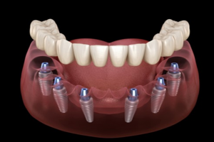 Implant toàn hàm - Hàm răng giả thế hệ mới, tự tin ăn nhai mọi món ngon