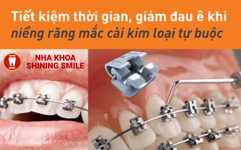 Sự Thật Về Niềng Răng: Có Làm Giảm Tuổi Thọ Không?