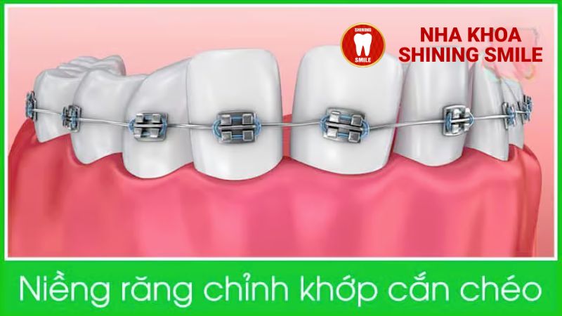 Tác Hại Của Việc Trồng Răng Implant - Những Điều Bạn Cần Biết