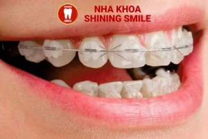 Niềng Răng Mắc Cài Sứ Có Đau Không? Giải Đáp Thắc Mắc