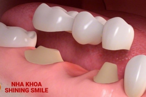 Chi Phí Trồng Răng Hàm Bị Sâu: Bạn Cần Biết Bao Nhiêu?