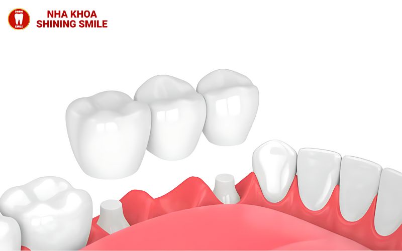 Top 3 Trụ Implant Hàn Quốc Đáng Chú Ý Cho Nụ Cười Hoàn Hảo