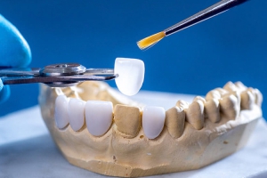 Răng Sứ Lisi: Độ Bền và Thẩm Mỹ Vượt Trội