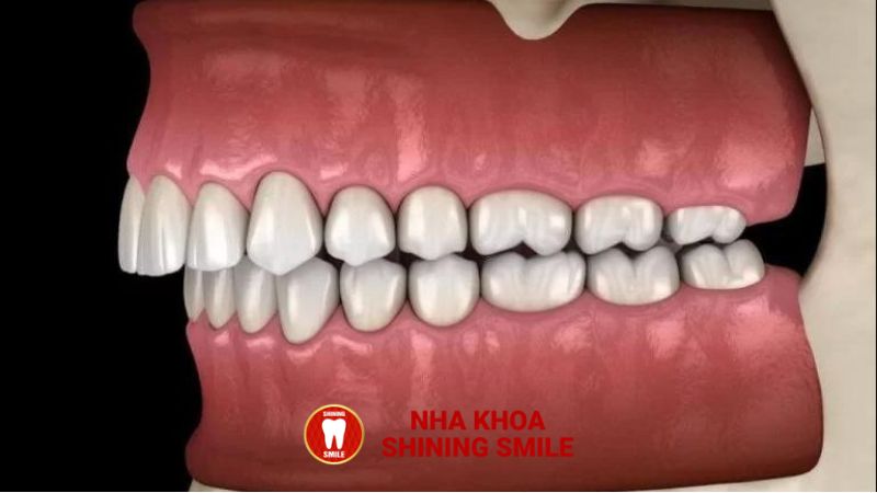 Quy Trình Trồng Răng Implant - Giải Pháp Hoàn Hảo Cho Nụ Cười Tự Tin
