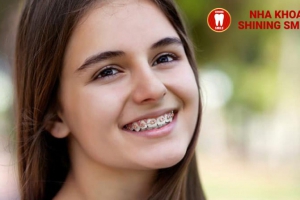 24, 25, 26 Tuổi Niềng Răng Được Không: Liệu Có Quá Muộn Để Cải Thiện Nụ Cười?