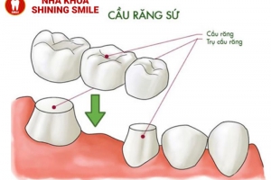 Hiệu Quả Và Ưu Nhược Điểm Khi Làm Cầu Răng Sứ - Những Điều Bạn Cần Biết