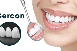 Răng sứ Cercon: Lựa chọn tối ưu cho nụ cười tươi sáng rạng rỡ