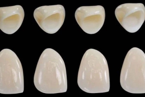 Bảng Giá Răng Sứ Không Kim Loại: Thông Tin Cần Biết