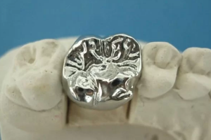 Bọc Răng Inox Giá Bao Nhiêu? Thông Tin Chi Tiết