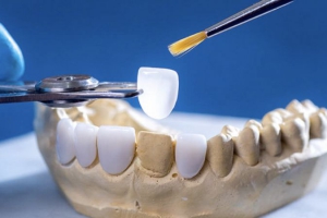 Bọc Răng Sứ Cho Răng Sâu: Giải Pháp Nhanh Chóng Và Hiệu Quả