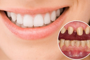 Bọc Răng Sứ Có Bị Rơi Ra Không? Sự Thật Về Độ Bền