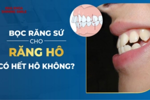 Bọc Răng Sứ Có Hết Hô Không? Tìm Hiểu Ngay