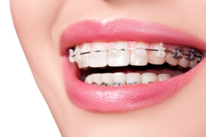 Bọc Răng Sứ Có Niềng Răng Được Không? Giải Đáp Thắc Mắc