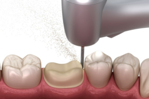 Giải Pháp Cho Tình Trạng Bọc Răng Sứ Khó Nhai
