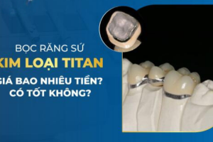 Bọc Răng Sứ Kim Loại Titan Giá Bao Nhiêu Tiền? Có Tốt Không?