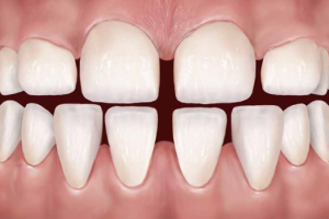 Bọc Răng Thưa Bao Nhiêu Tiền? Bảng Giá Mới Nhất