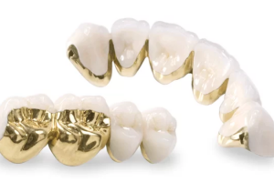 Bọc Sứ Răng Cấm Bao Nhiêu Tiền? Thông Tin Giá Cả