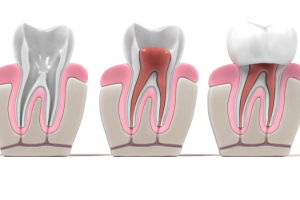 Bọc Sứ Cho Răng Cửa Bị Sâu: Giải Pháp Hiệu Quả