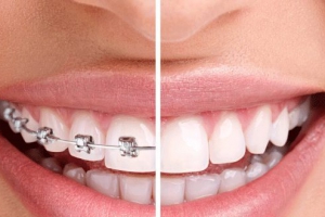 Nên niềng răng hay bọc sứ sẽ tốt hơn?